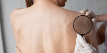 La ciencia argentina da un paso clave en el tratamiento del cáncer de piel